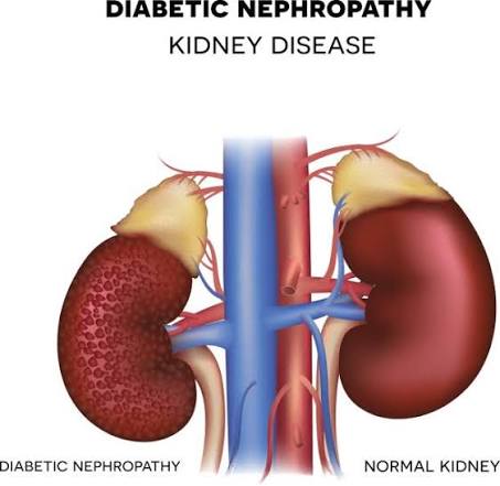 Best Diabetic kidney Disease in Powai